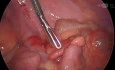 Laproscopic Appendectomy 03- Early Appendicitis in 10 years Old Boy