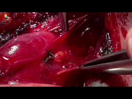 Identification of Parathyroid Gland