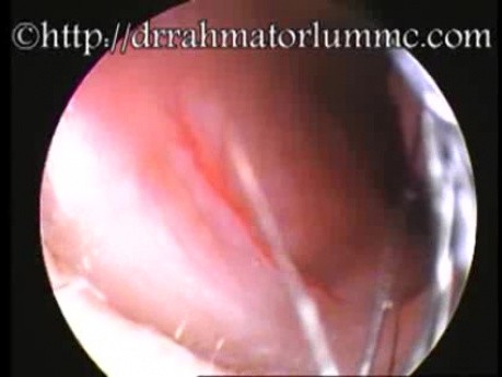 The Use of Aural Speculum To Avoid Nasal Vibrissae for Better Viewing of Little's Area 