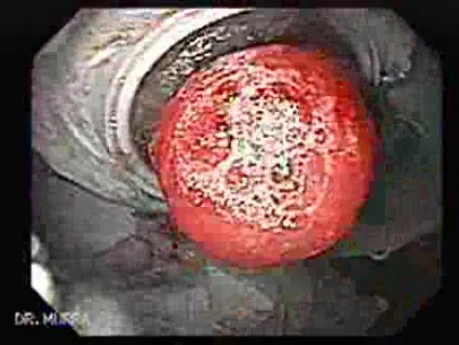 Ileal Neobladder Substitution (ileal bladder) (8 of 9)