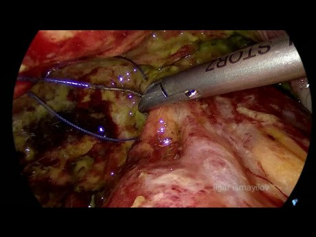Minimally Invasive Management of the Anastomotic Leakage