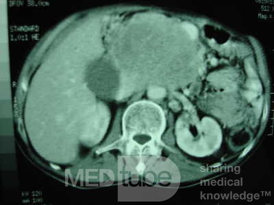 Gastric Ulcer with Gastrocolic fistula due to a Zollinger-
 Ellison Syndrome (25of 33)