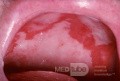 Benign Mucous Membrane Pemphigoid