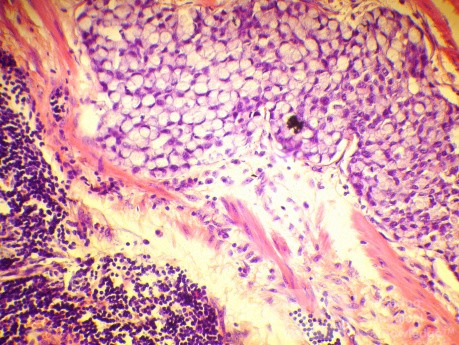 Endoscopy of Scirrhous Gastric Carcinoma involving the entire Fundus, Body and the Antrum (45 of 47)