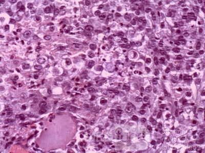 Lung Adenocarcinoma (3 of 5)