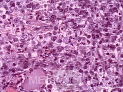 Lung Adenocarcinoma (3 of 5)