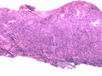 Lymphoma B small cells of the Jejuno (9 of 10)