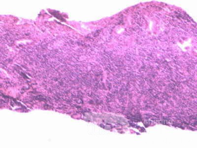 Lymphoma B small cells of the Jejuno (9 of 10)