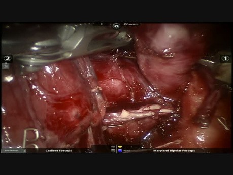 Case of Lung Cancer - Protocol of Neoadjuvant Treatment