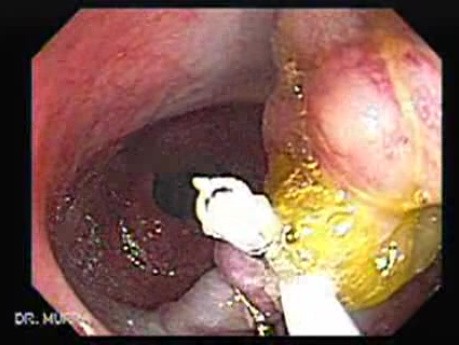 Colonoscopic Polypectomy (12 of 18)