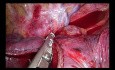 Uniportal VATS Anatomic Right Bisegmentectomy S2+S3