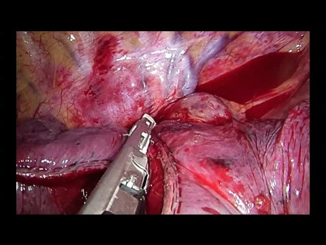 Uniportal VATS Anatomic Right Bisegmentectomy S2+S3