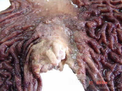 Adenocarcinoma of the cardias and gastric fundus with signet-ring cells (16 of 25)