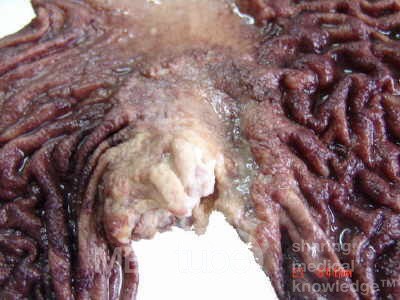 Adenocarcinoma of the cardias and gastric fundus with signet-ring cells (16 of 25)