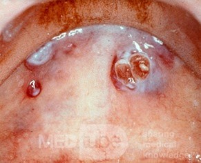 Kaposi's Sarcoma [palate]