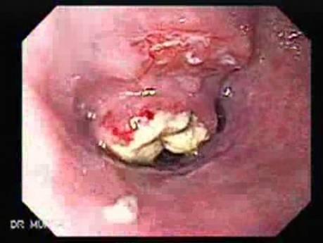 Small Cell Carcinoma of theLung that Invades the Upper and the Middle Third of the Esophagus - Presentation of Neoplastic Infiltration
