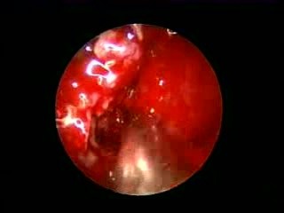 Eosinophilic Fungal Rhinosinusitis (EFRS) With Proptosis And Skull Base Erosion