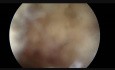 FLA in Endoscopic Spine Surgery