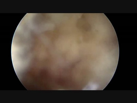 FLA in Endoscopic Spine Surgery