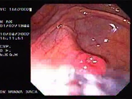Cecum: Appendiceal Orifice