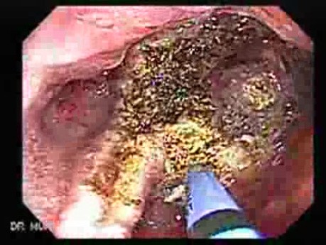 Multiple Adenomatous Polyps Of The Rectum (27 of 37)