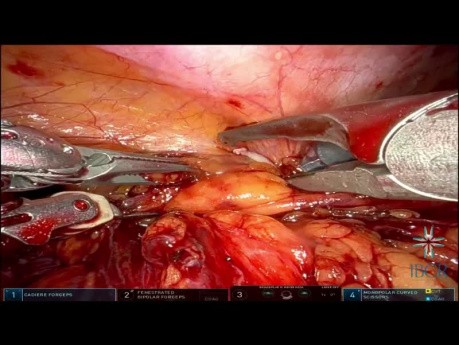 A new Strategy: Robotic Termino-Terminal Urethroplasty with Aid of Indocyanine Green and Firefly Mode to Locate Narrowing Point
