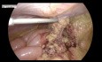 Laparoscopic Repair of Recurrent Umbilical Hernia