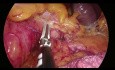 Total Mesorectal Excision (TME) - Medial to Lateral Splenic Flexure Mobilization.