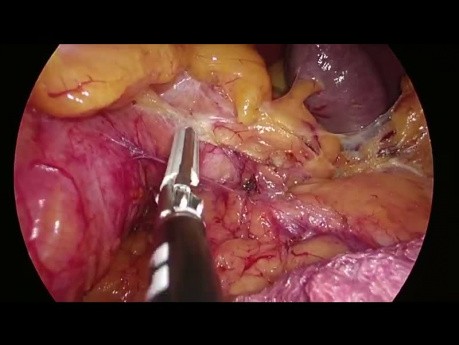 Total Mesorectal Excision (TME) - Medial to Lateral Splenic Flexure Mobilization.