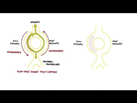 AVRNT (Atrioventricular Re-Entry Tachycardia) - Causes, Pathophysiology, Treatment