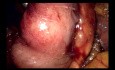 Lap Whipple Resection - Part 1