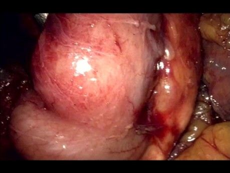 Lap Whipple Resection - Part 1