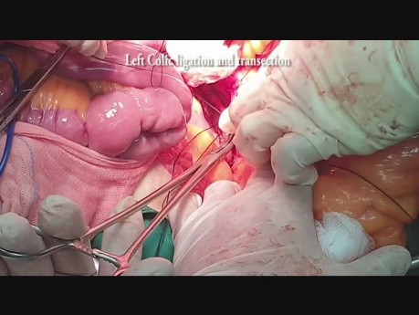 Superior Rectal Artery Sparing (Open)