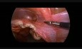 Laparoscopic Resection of the Twisted Fallopian Tube