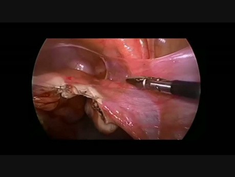 Laparoscopic Resection of the Twisted Fallopian Tube