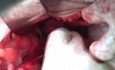 Radical Wertheim Hysterectomy With Bilateral Pelvic Lymph Node Excision