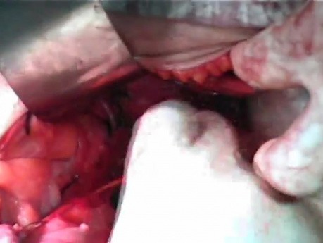 Radical Wertheim Hysterectomy With Bilateral Pelvic Lymph Node Excision