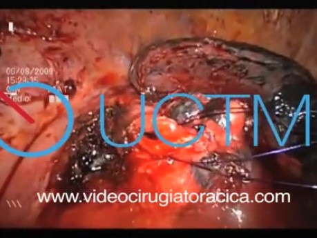Bronchoplastic VATS right lower lobectomy lung cancer