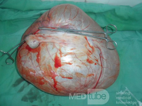 Huge left ovarian cyst 1