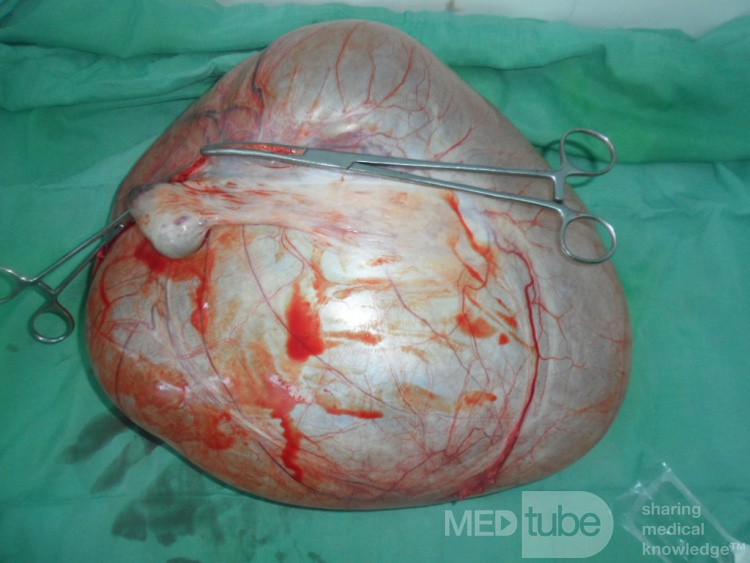 Huge left ovarian cyst 1