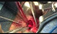 Ligation of Intersphincteric Fistula Tract