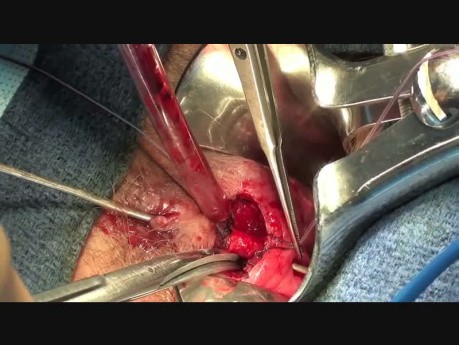 Ligation of Intersphincteric Fistula Tract