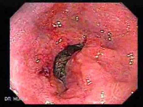 Adenocarcinoma of the Antrum with Duodenal Infiltration (2 of 3)