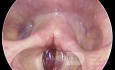 Vocal Cord Haematoma