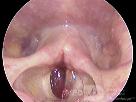 Vocal Cord Haematoma