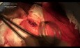 Whipple procedure ( Pancreatojejunostomy )