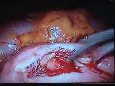 Jejunal Gastrointestinal Stromal tumor (GIST) (40 of 86)