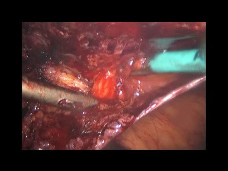 Ventral TAPP by Laparoscopy Combined with Inguinal TAPP (Annotated)