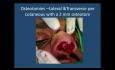 Rhinoplasty Classes - the Telescoping Nose