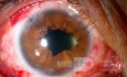 Ocular trauma (after)
